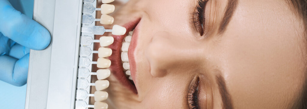 cosmetics consultation for veneers & crowns