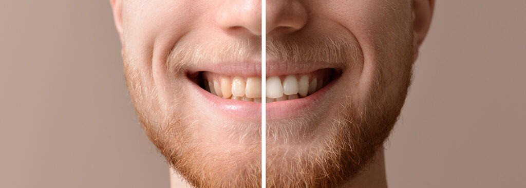 new patient in-office teeth whitening
